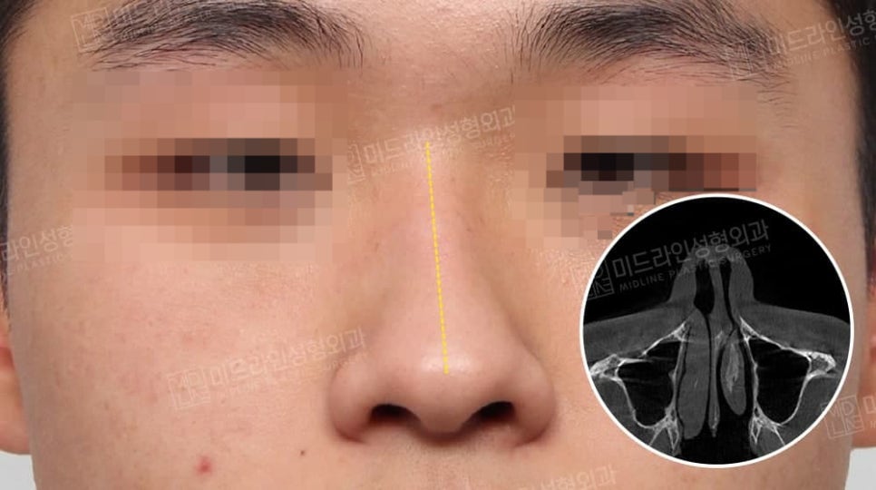 휜 코, 매부리 교정과 기능코-비중격만곡증까지 바로잡기 관련 이미지 1