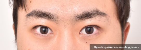 반드시 절개눈매교정으로 해야 하는 경우를 성형외과 전문의가 알려드립니다. 관련 이미지 9