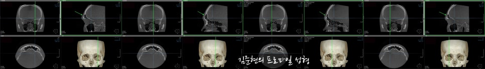 눈썹뼈절삭, 어떨 때 어떻게 하는 수술일까요? 꼭 이마거상과 함께 해야만 하는 수술인가요? 미드라인성형외과에서 하는 눈썹뼈절삭 수술을 설명드립니다. (3D CT 있음) 관련 이미지 18