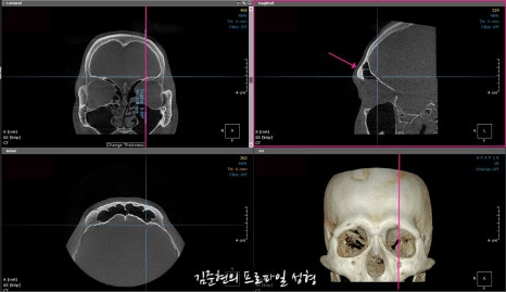 눈썹뼈절삭, 어떨 때 어떻게 하는 수술일까요? 꼭 이마거상과 함께 해야만 하는 수술인가요? 미드라인성형외과에서 하는 눈썹뼈절삭 수술을 설명드립니다. (3D CT 있음) 관련 이미지 5