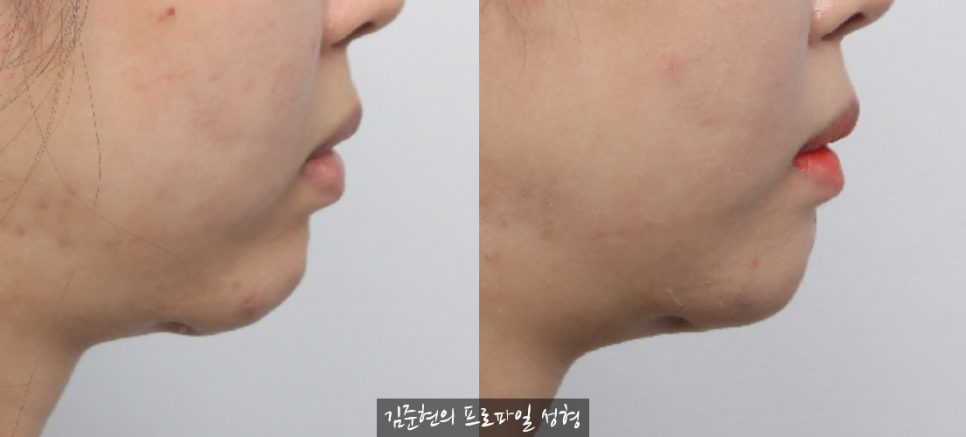 앞턱 보형물이 턱 아래로 뚫고 나와요..ㅠㅠ 앞턱 보형물 제거 후 턱끝 전진술한 경우를 성형외과 전문의가 설명드립니다. 관련 이미지 7