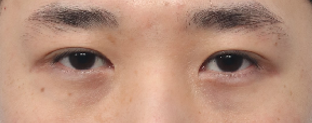 What Type of Plastic Surgery Is Needed for Small, Cramped Eyes? (About Lateral, Lower, and Combined Lateral-Lower Canthoplasty) image 10