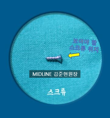 윤곽 후 핀제거 수술 케이스, 꼭 필요한 것인가? 관련 이미지 9
