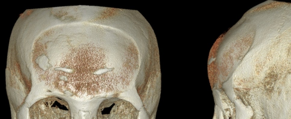 I want to remove my forehead implant because it makes my forehead look too voluminous, and I also want a forehead lift at the same time. (Feat. under-eye fat repositioning + fat grafting) image 3