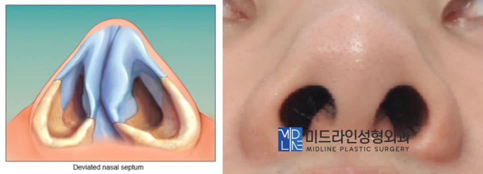 The Plastic Surgery Specialist Explains Septoplasty, One of the Methods for Functional Nose Surgery for Rhinitis. (feat. Swing-door Technique) image 3