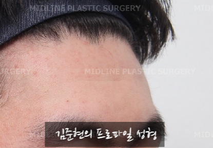 Let’s Learn About the Effects of Brow Bone Reduction Surgery. (Brow Bone? Eye Hole Bone? Here’s a Terminology Guide.) image 2