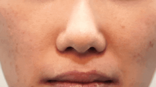 코막힘 원인, 비밸브재건술에 대하여 성형외과 전문의가 설명드립니다. 관련 이미지 2
