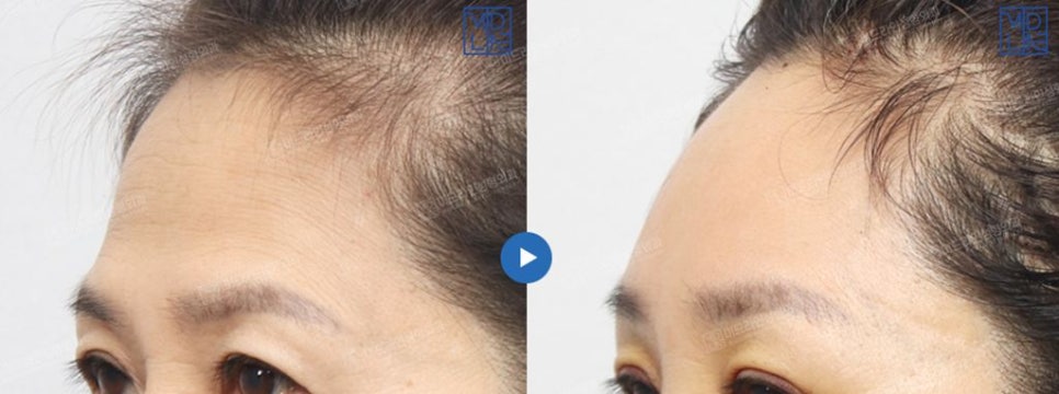 Endoscopic forehead lift that removes wrinkles and creates natural forehead volume! image 13