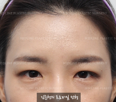 이마거상이 필요한 전형적인 케이스를 소개합니다! 더 일찍 할 껄ㅠㅠ하지 마시고 지금이 제일 빠를 때입니다. (Feat. 눈밑지방재배치와 눈밑지방이식) 관련 이미지 1