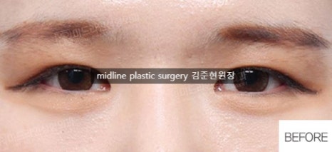 Forehead lift for people in their 20s and 30s: correcting eyelid sagging and even eye asymmetry! image 3