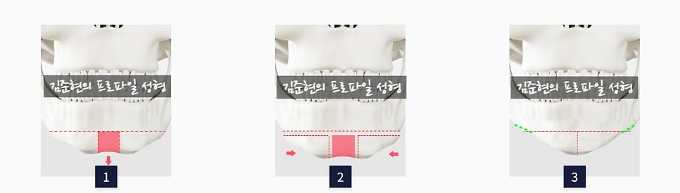 턱끝전진술로 생긴 이차각은 어떻게 되나요?! 관련 이미지 5