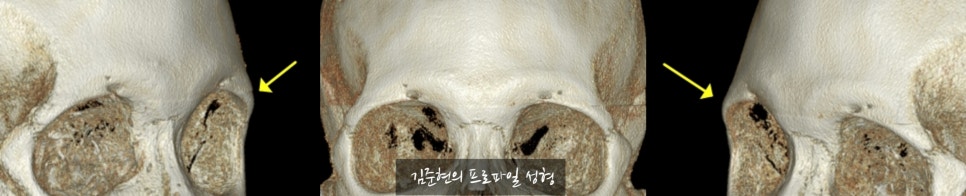"아이홀뼈가 튀어나와서 보기 싫어요. " 아이홀뼈 절삭에 관하여 성형외과 전문의가 설명드립니다. 관련 이미지 5