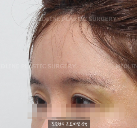 I want to go back to how it was before the forehead liftㅠ Is forehead lift reversal or release possible? image 8