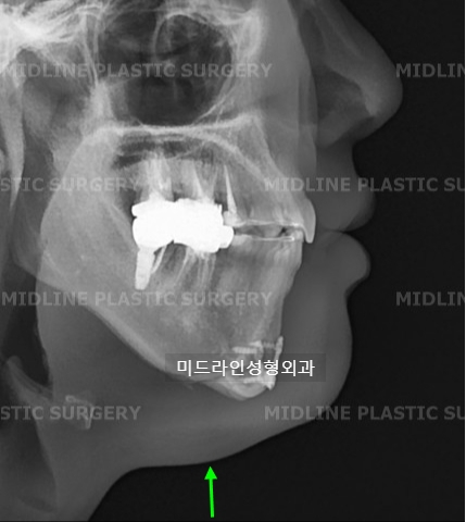 A Plastic Surgeon Explains the Changes in the Front and Side Views After Reduction Genioplasty and Advancement Genioplasty. (Feat. Rhinoplasty) image 4