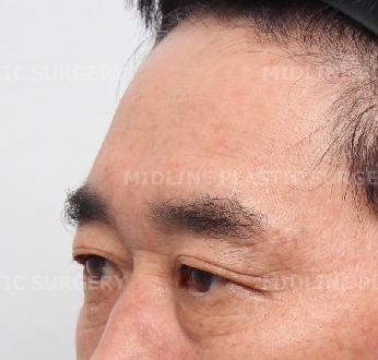 Endoscopic forehead lift that removes wrinkles and creates natural forehead volume! image 1