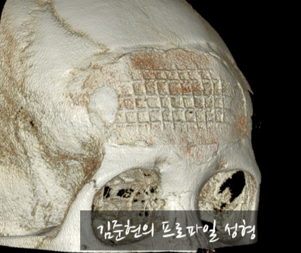 I Removed Two Forehead Implants. A Board-Certified Plastic Surgeon Explains Why I Do Not Recommend Forehead Implants. image 9