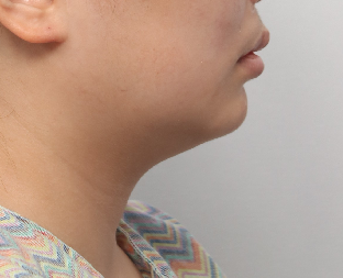 A Plastic Surgery Specialist Explains Why Chin Liposuction Is Sometimes Essential Because Jaw Reduction Surgery Alone Has Limited Effect image 6