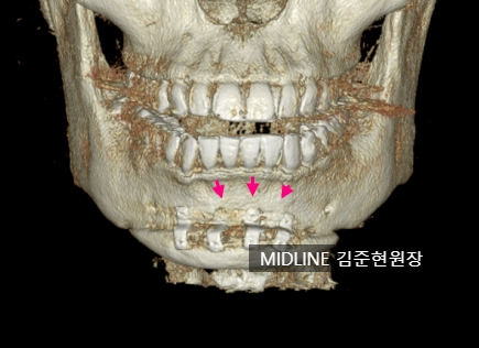 윤곽 후 핀제거 수술 케이스, 꼭 필요한 것인가? 관련 이미지 7