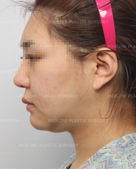 Fixing Sagging After Facial Contouring Surgery with a Face Lift!! (Feat. Plate Removal, Plate & Screw Removal) image 4