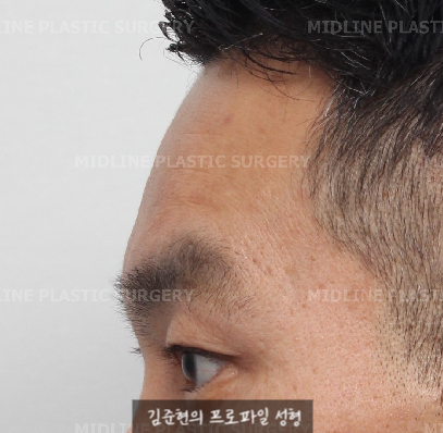 쌍꺼풀을 하려는데 이마주름이 심각해요....어떡하죠? 상남자의 자연스런 쌍꺼풀 만들기(Feat. 내시경 이마거상) 관련 이미지 6