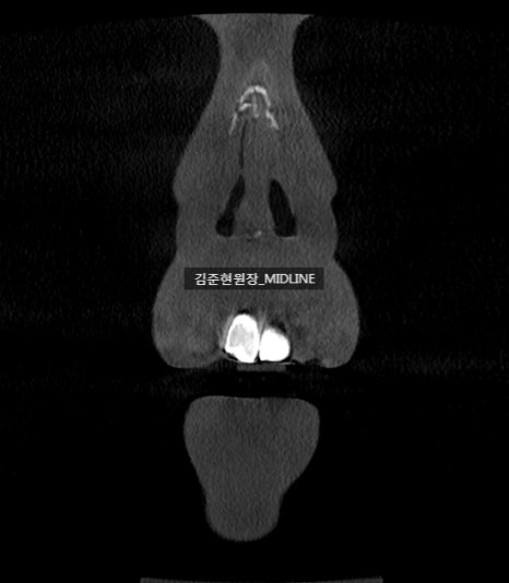 휜 코, 매부리 교정과 기능코-비중격만곡증까지 바로잡기 관련 이미지 37