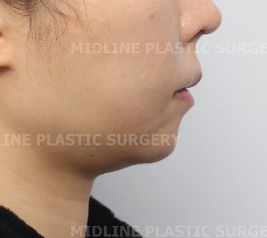 A Specialist Explains Chin Advancement Surgery After Removal of a Receded Chin Implant image 8