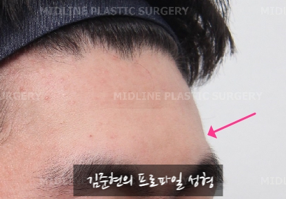 Let’s Learn About the Effects of Brow Bone Reduction Surgery. (Brow Bone? Eye Hole Bone? Here’s a Terminology Guide.) image 4