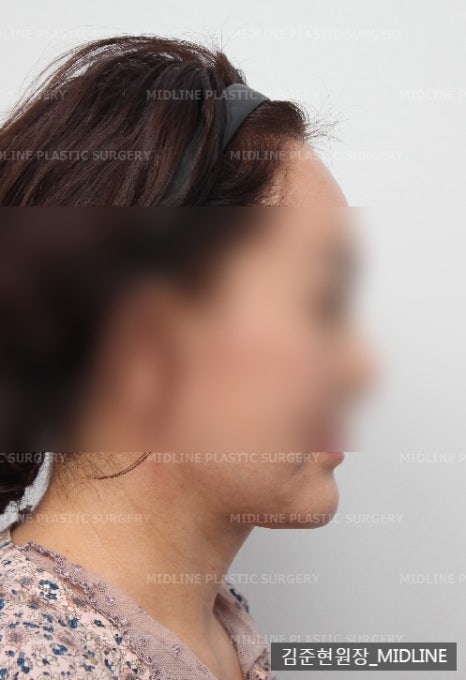 얼굴 주름 리프팅, 오래 지속되고 효과 좋은 수술방법은? 관련 이미지 15