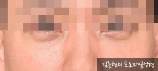 성형외과 전문의가 눈밑수술 케이스의 진단방법 및 나이들면 하는 수술이다라는 오해에 대해 설명해드립니다. 관련 이미지 8