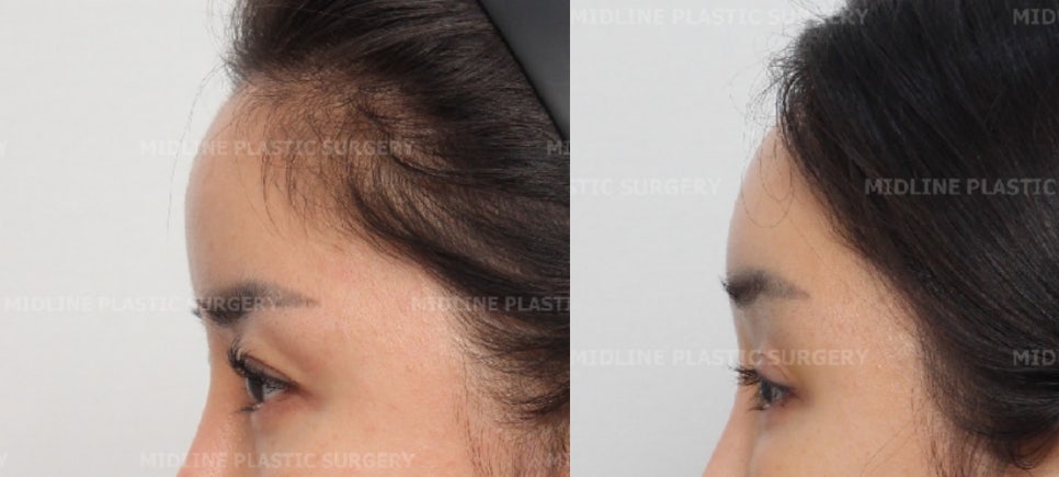 I want to remove my forehead implant because it makes my forehead look too voluminous, and I also want a forehead lift at the same time. (Feat. under-eye fat repositioning + fat grafting) image 5