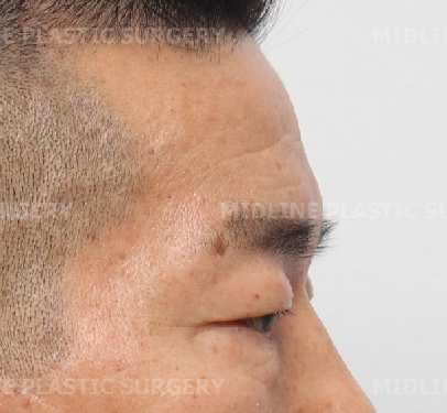 When Should Endoscopic Forehead Lift and Brow Lift Be Performed at the Same Time? (Feat. Lower Blepharoplasty) image 7