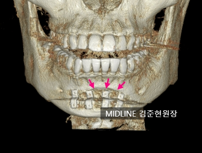 윤곽 후 핀제거 수술 케이스, 꼭 필요한 것인가? 관련 이미지 6