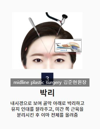 Headache, vomiting, pain, nausea after forehead lift... is it a side effect?! Here's my answer. image 8