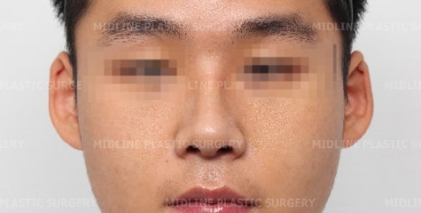 휜 코, 매부리 교정과 기능코-비중격만곡증까지 바로잡기 관련 이미지 21