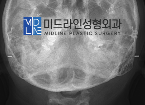 A Plastic Surgery Specialist Explains Why Chin Liposuction Is Sometimes Essential Because Jaw Reduction Surgery Alone Has Limited Effect image 9