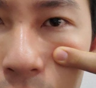 코막힘 원인, 비밸브재건술에 대하여 성형외과 전문의가 설명드립니다. 관련 이미지 5