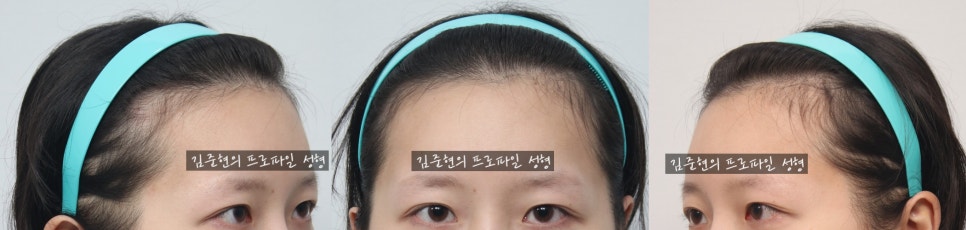 My Double Eyelids Are Hidden and I Want a Forehead Lift, But My Forehead Is Also Wide. What Should I Do? A Plastic Surgery Specialist Explains. (Forehead Lift + Forehead Reduction at the Same Time!) image 3