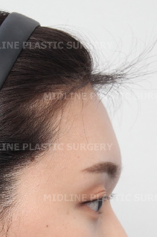 Forehead Lift for a Forehead with Prominent Brow Bones?? image 7