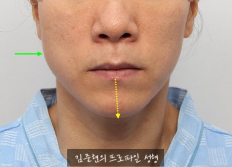 수술없이 간단하게 안면비대칭, 턱끝 비대칭(미드라인 맞추기) 해결하기!! 관련 이미지 12