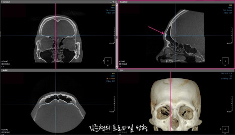 눈썹뼈절삭, 어떨 때 어떻게 하는 수술일까요? 꼭 이마거상과 함께 해야만 하는 수술인가요? 미드라인성형외과에서 하는 눈썹뼈절삭 수술을 설명드립니다. (3D CT 있음) 관련 이미지 7