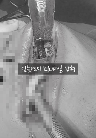 안전하고 예측 가능한 광대축소술. 성형외과 전문의가 알려드립니다. (feat. 미드라인성형외과) 관련 이미지 7