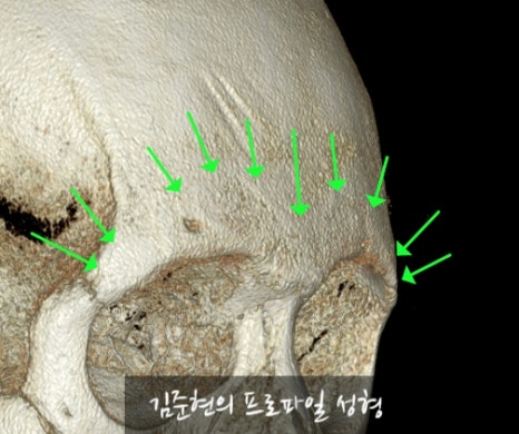 Let’s Learn About the Effects of Brow Bone Reduction Surgery. (Brow Bone? Eye Hole Bone? Here’s a Terminology Guide.) image 19