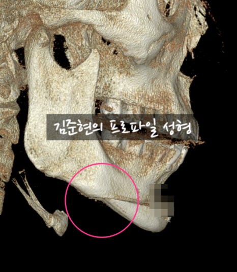 턱끝전진술로 생긴 이차각은 어떻게 되나요?! 관련 이미지 2