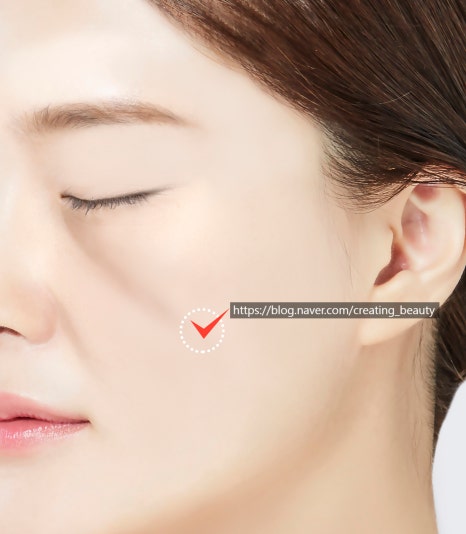 인디언 주름 고민 해결! 중안면부 리프팅에 대하여 설명드립니다. 관련 이미지 8
