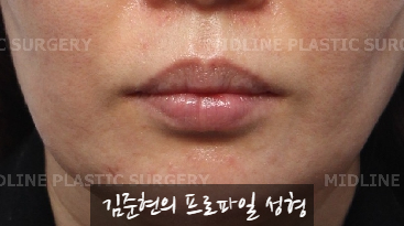 입술에 볼륨을 주는 방법은? 입술 지방이식에 관하여 관련 이미지 13
