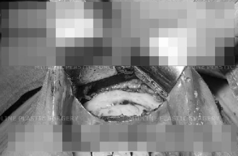 앞턱 보형물이 턱 옆으로 뚫고 나와요ㅠㅠ앞턱 보형물 제거 후 턱끝전진술을 한 케이스를 성형외과 전문의가 설명합니다. 관련 이미지 14