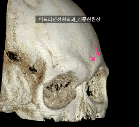 눈썹뼈 절삭에 관하여 (안와상융기) 관련 이미지 18
