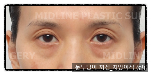Sallow Eyes, Sunken Eyes Solved with Fat Grafting! (Feat. Dark Circles) image 1