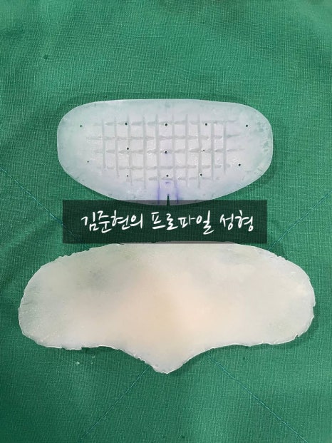 I Removed Two Forehead Implants. A Board-Certified Plastic Surgeon Explains Why I Do Not Recommend Forehead Implants. image 12