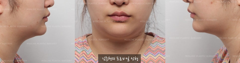 이중턱이 고민이에요ㅠㅠ숨은 턱선을 찾아주는 이중턱, 턱라인 지방흡입! 미드업 2040에 관하여 설명드립니다. 관련 이미지 2